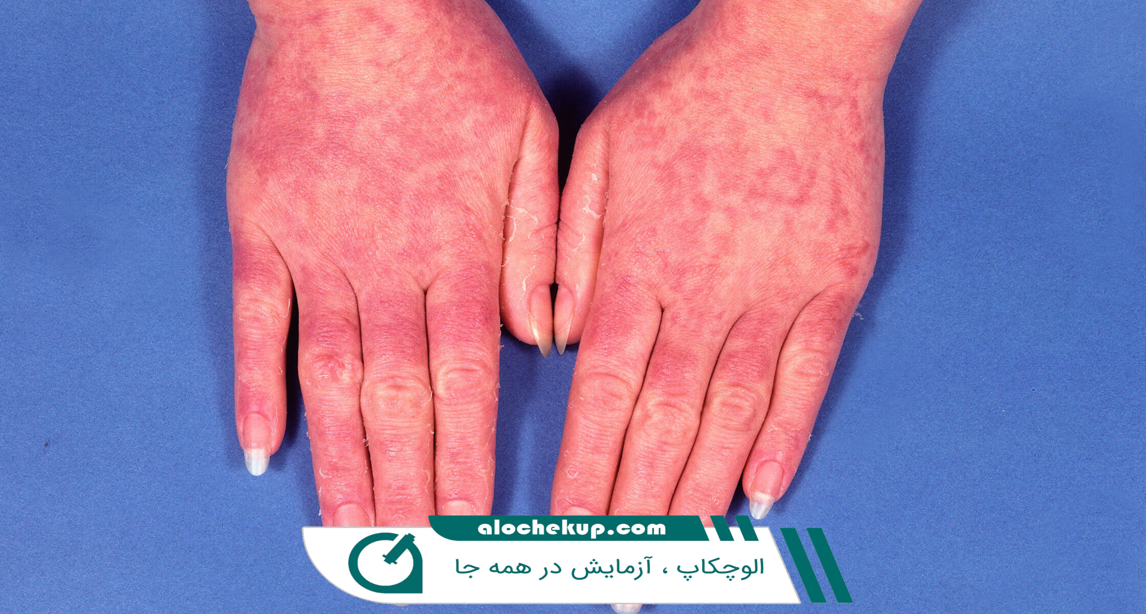 علائم بیماری لوپوس چگونه شناسایی می‌شوند؟